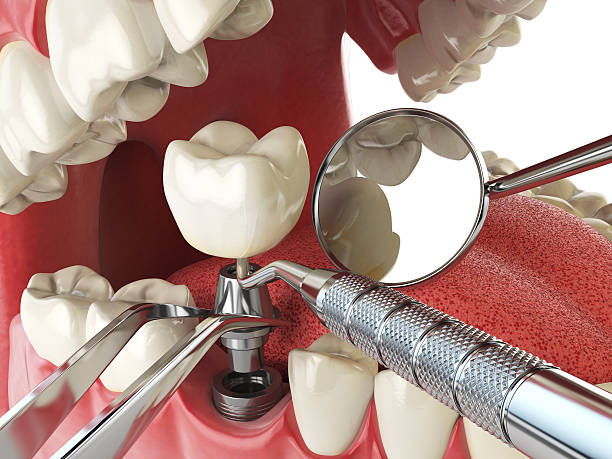 Best Broken or Chipped Tooth Repair in , MS